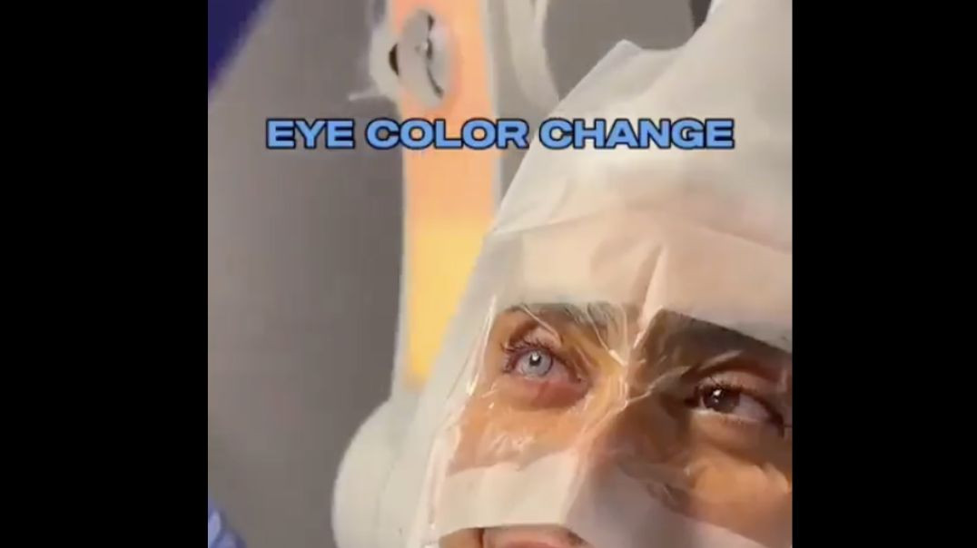 Eye Color Changing Surgery